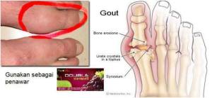 testimoni gout